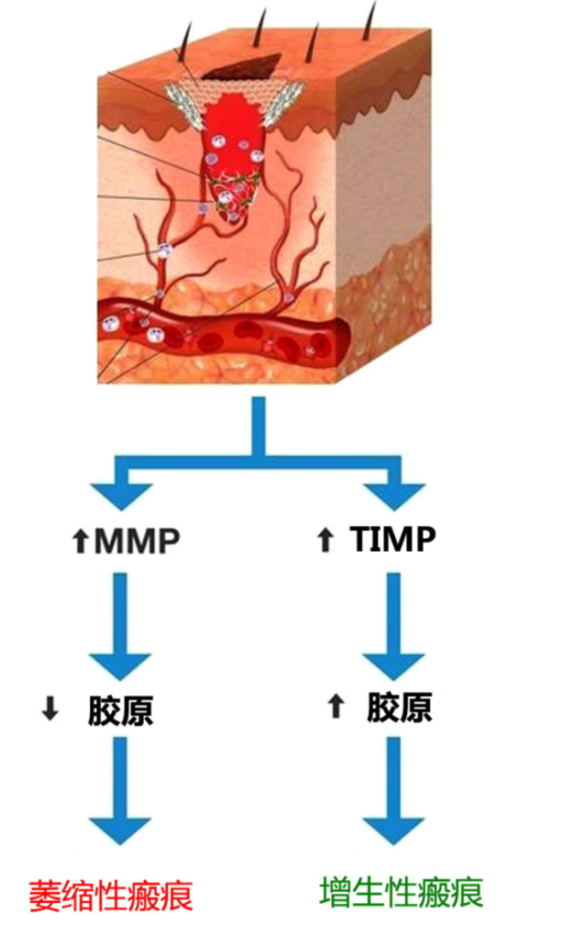 哪些痤疮患者容易留痘疤？