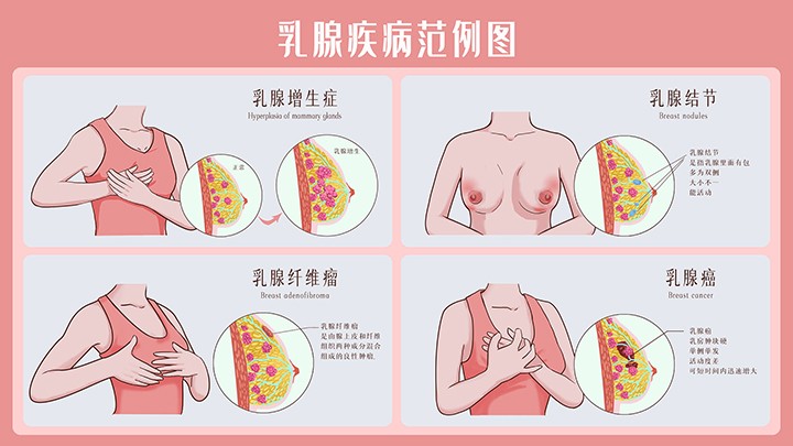 女生的乳房总是时不时疼痛？要注意这些情况！