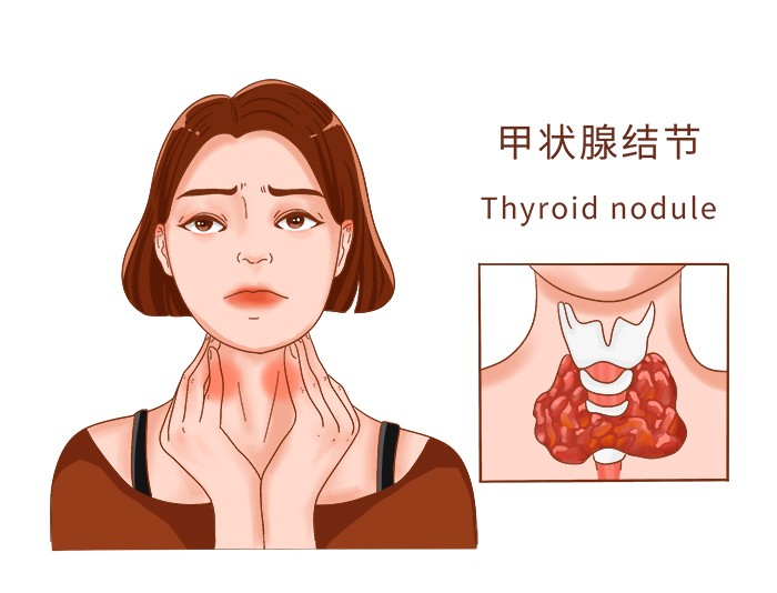甲状腺结节是怎么分级的？达到几级就是癌症呢？