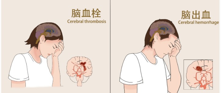 秋冬高发季｜脑出血是怎么回事儿？如何识别？如何预防？