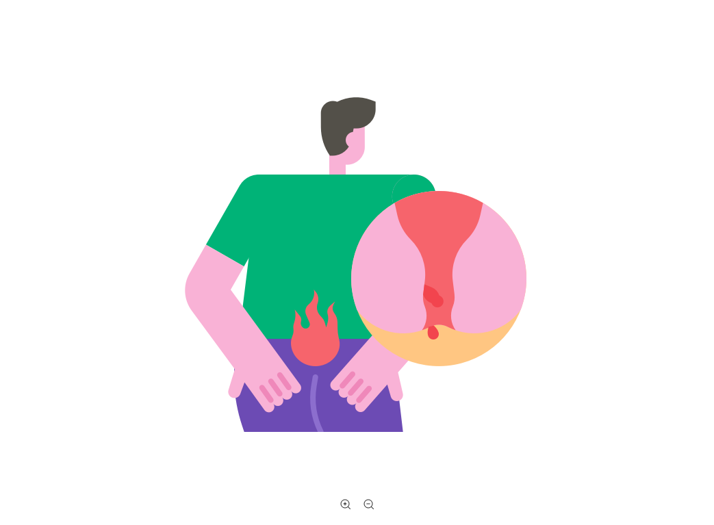 男子错把肛乳头肥大当痔疮，这些肛乳头肥大症状需知道