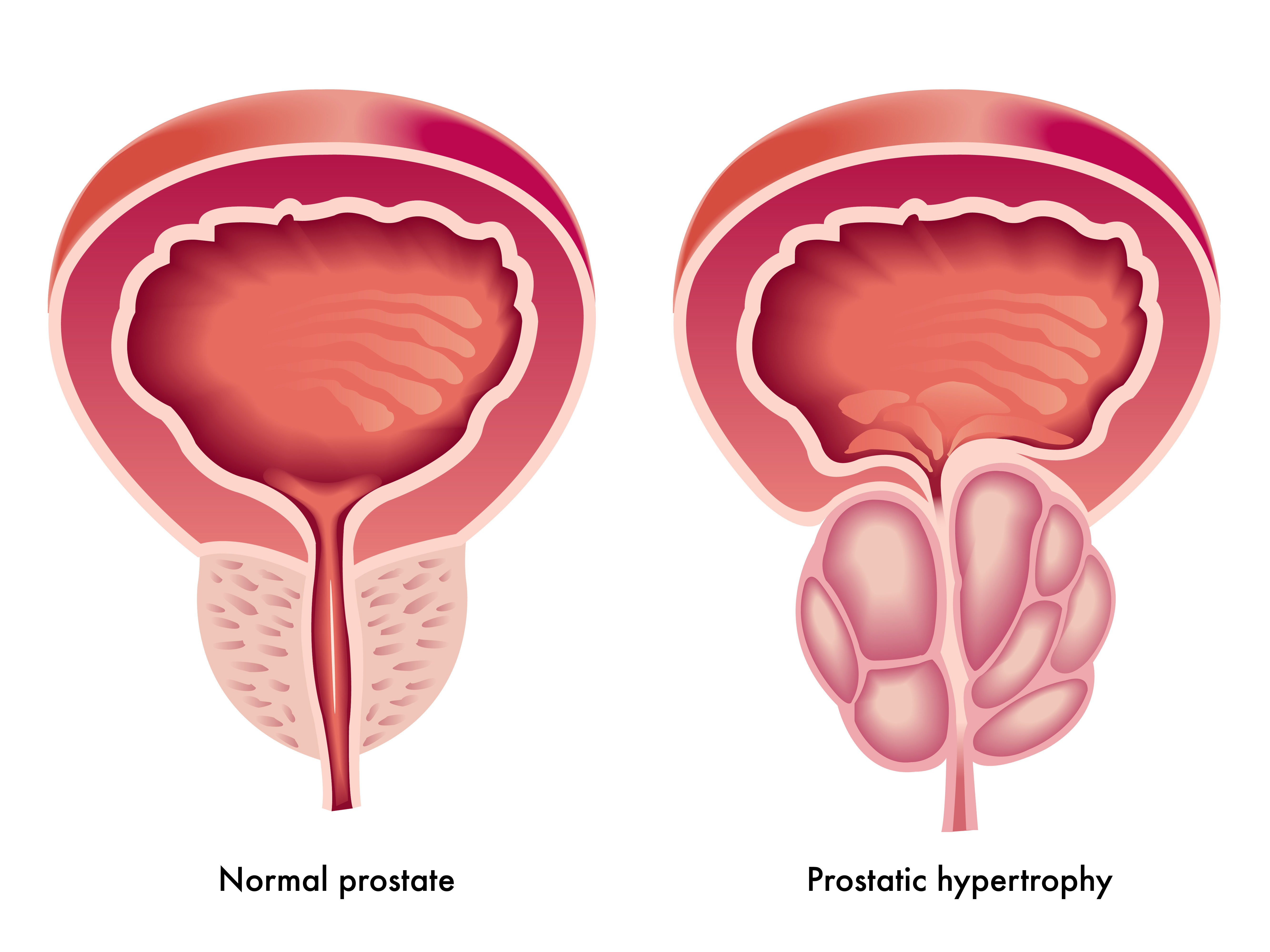 Prostatic hypertrophy 1.jpg