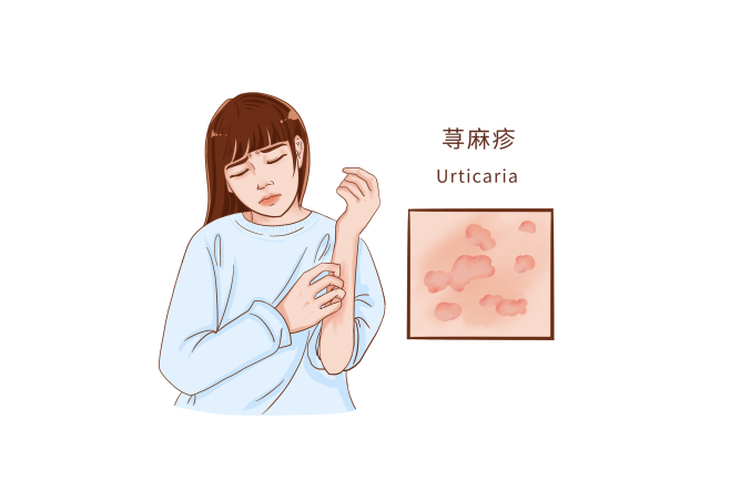 荨麻疹：皮肤上的“风团”怎么有效解决