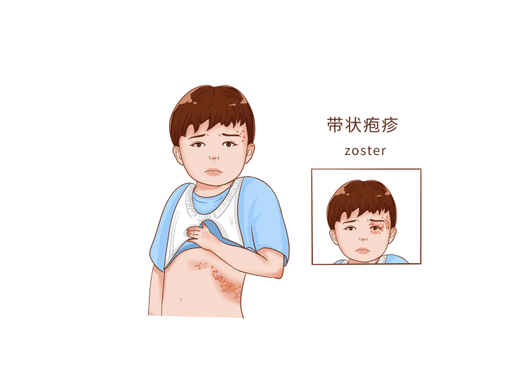 红斑、水疱、神经痛?警惕带状疱疹的“蛇缠腰”