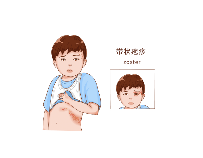 带状疱疹不是 “小水痘”！疼到失眠、留后遗症？这些信号千万别忽视