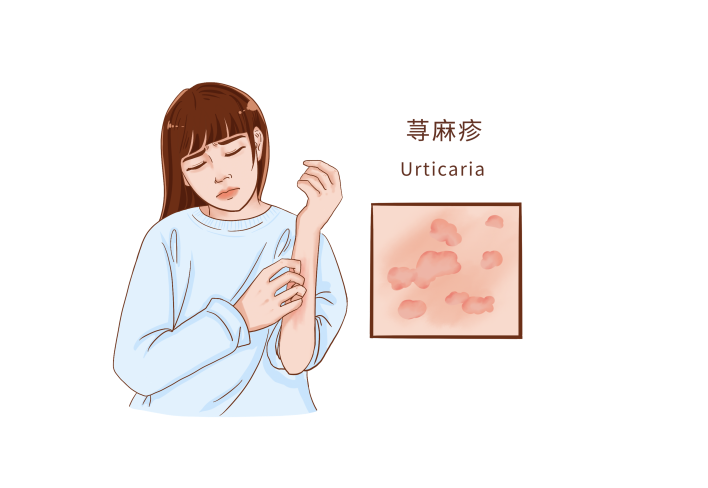 皮肤突然起“风团”？可能是荨麻疹