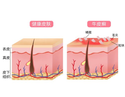 牛皮癣为什么越抓越痒？