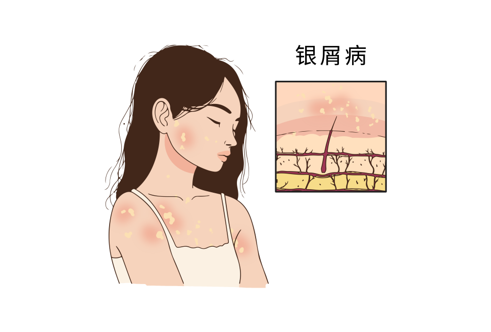 皮肤干燥脱屑？小心是银屑病！