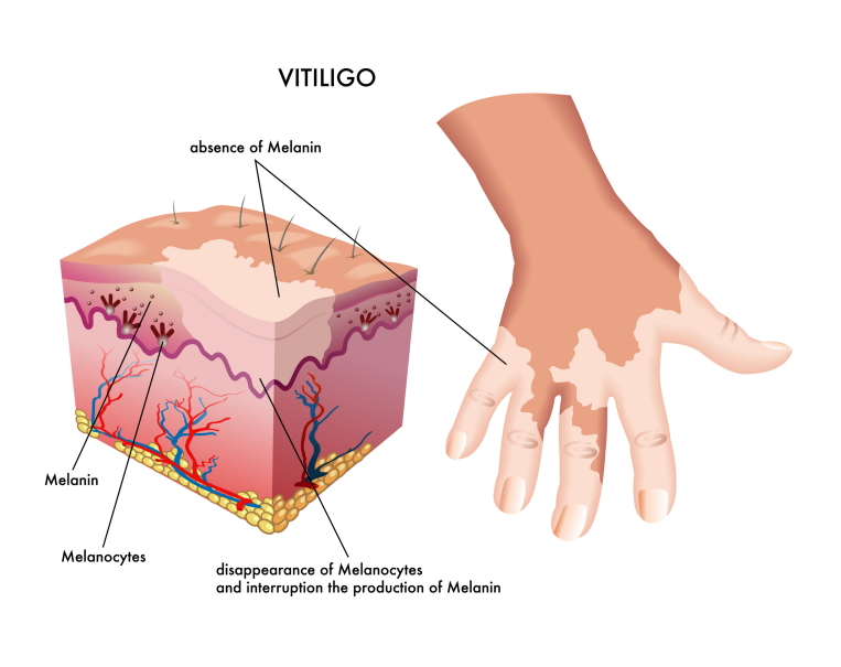 掌握三点白癜风小知识，从容面对不慌张！