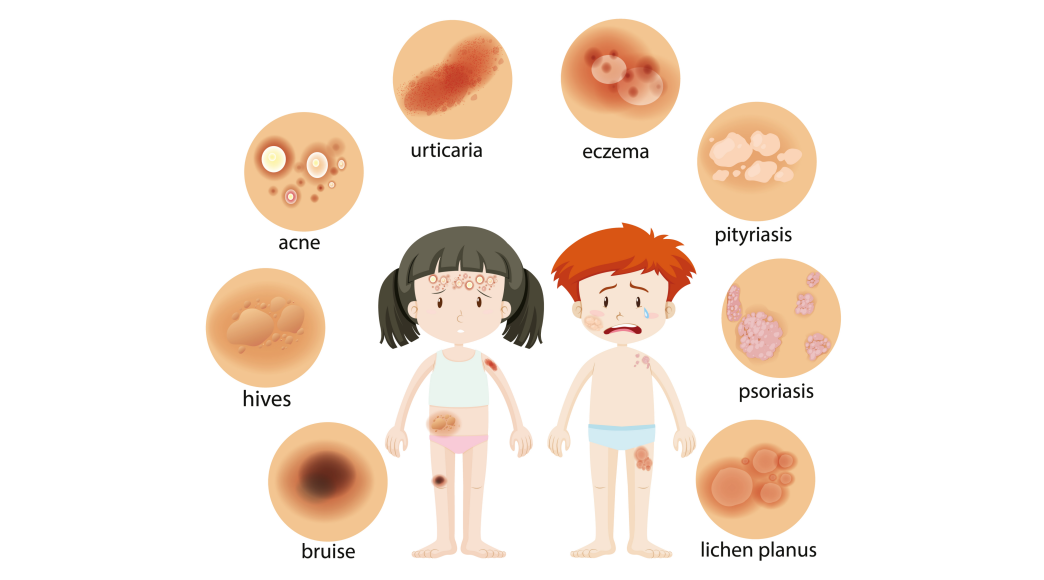 白癜风患者的诱因并不相同，看看你是哪一种？
