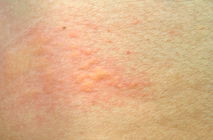 荨麻疹防治指南：别把“风团”当小事